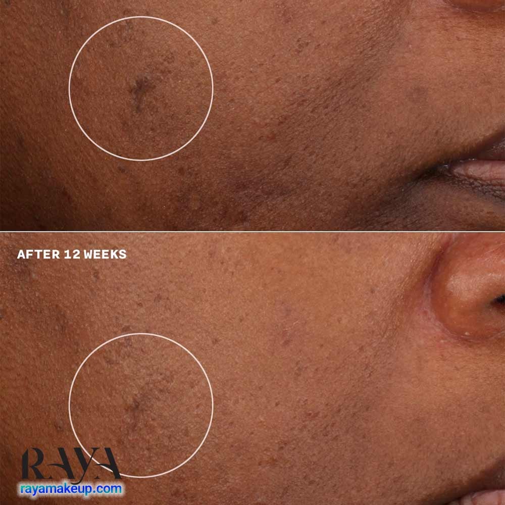 کرم مرطوب کننده و روشن کننده مدل ایون بتر کلینیکال کلینیک Clinique Even Better Clinical Brightening Moisturizer