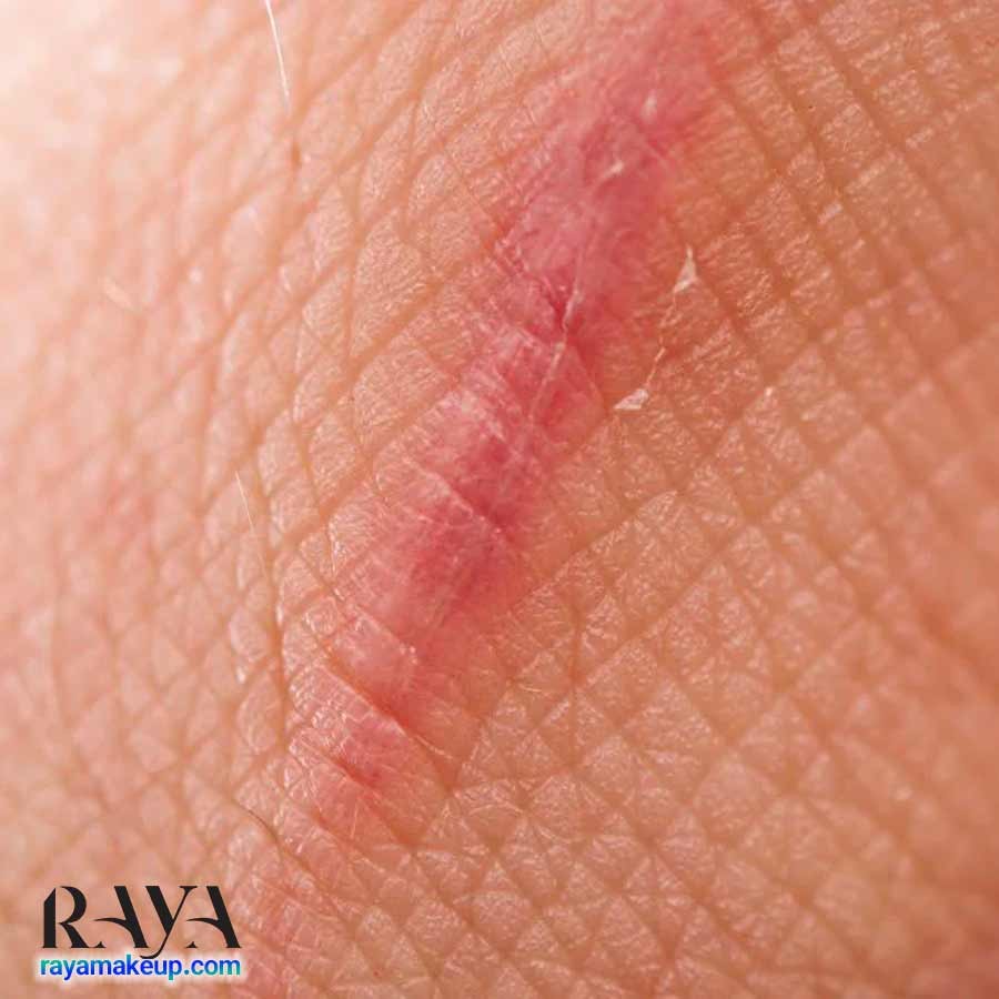 اسکار و لک جای زخم روی پوست