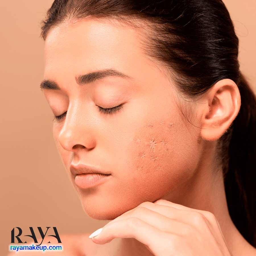 اسکار و لک جای زخم روی پوست