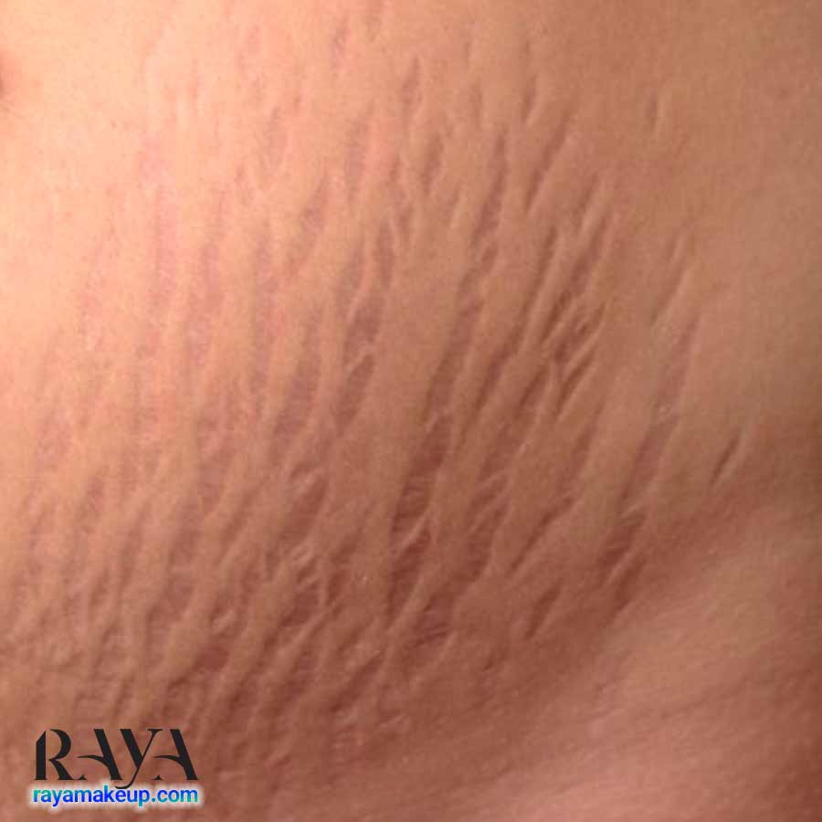 استرچ مارک یا ترک پوستی چیست؟ علت ایجاد ترک پوستی و راه های درمان آن