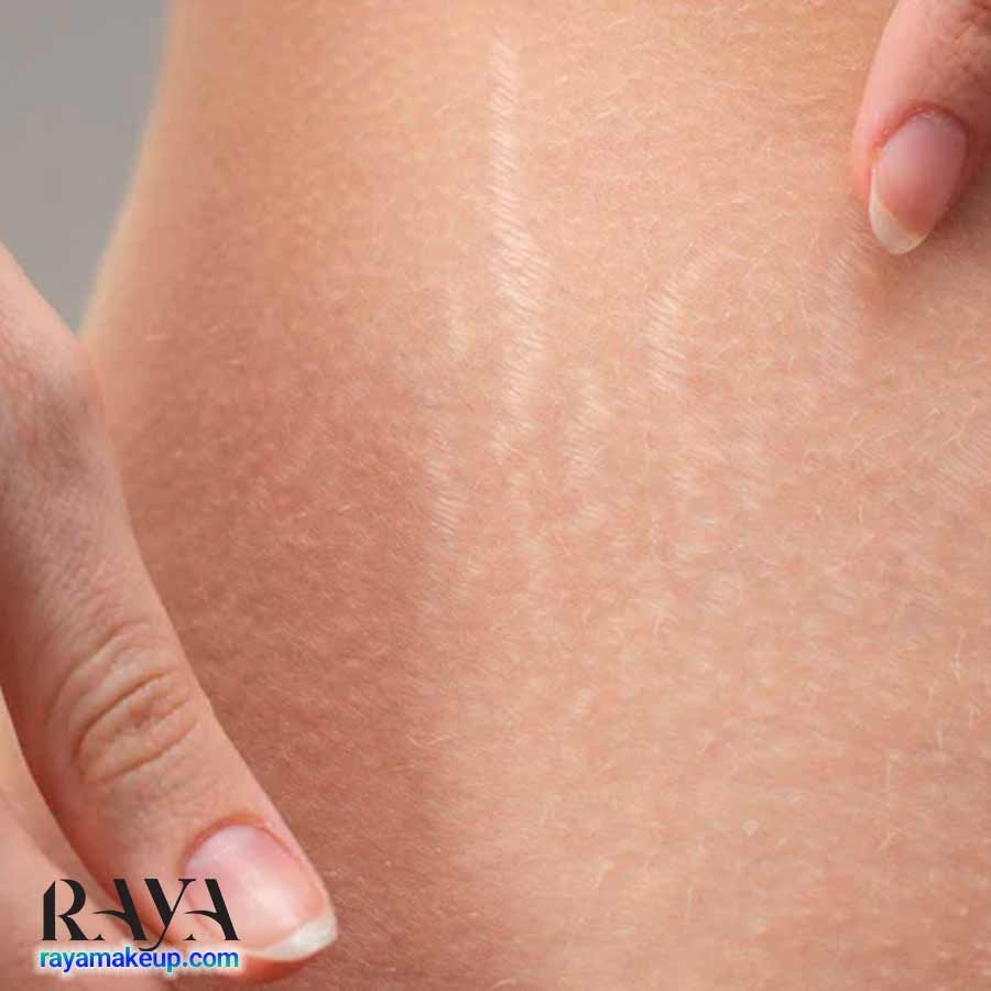 استرچ مارک یا ترک پوستی چیست؟ علت ایجاد ترک پوستی و راه های درمان آن