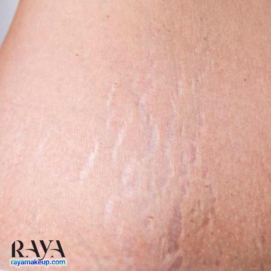 استرچ مارک یا ترک پوستی چیست؟ علت ایجاد ترک پوستی و راه های درمان آن