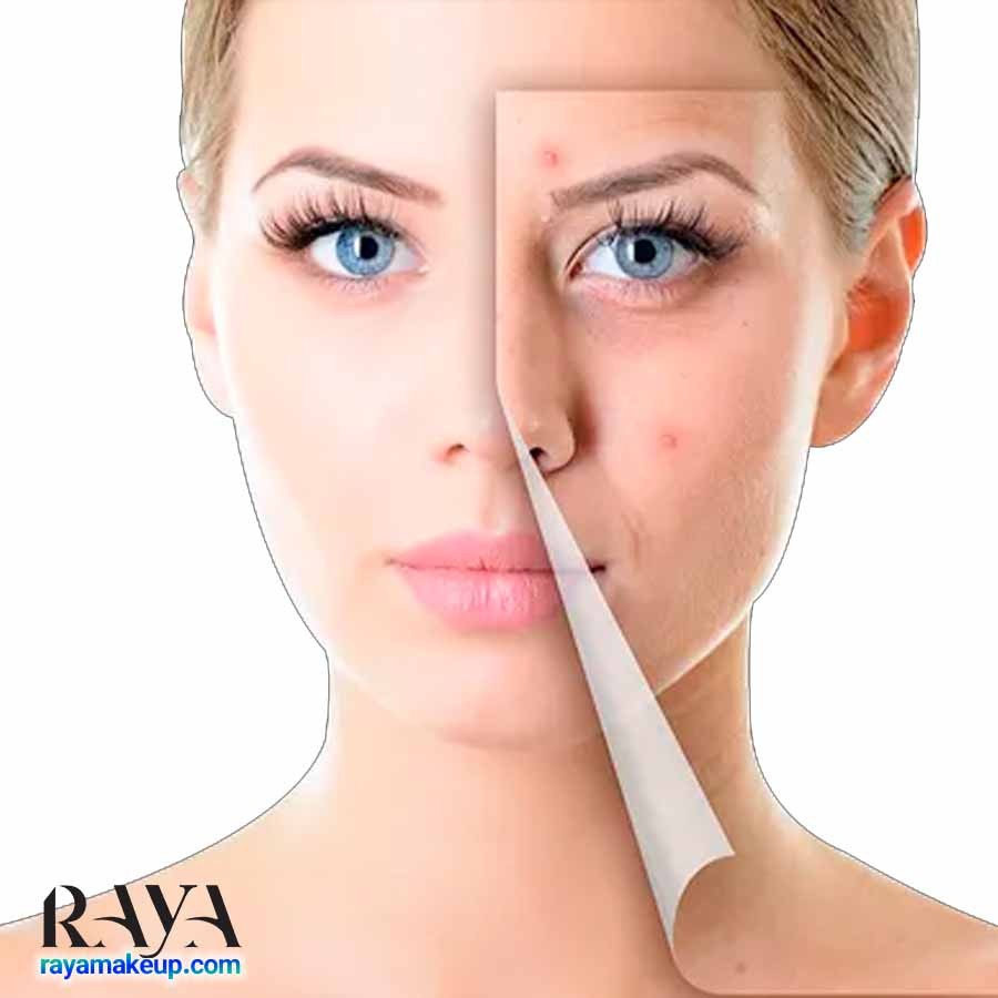 ژل ضد جوش و آکنه اورژانسی و فوری 