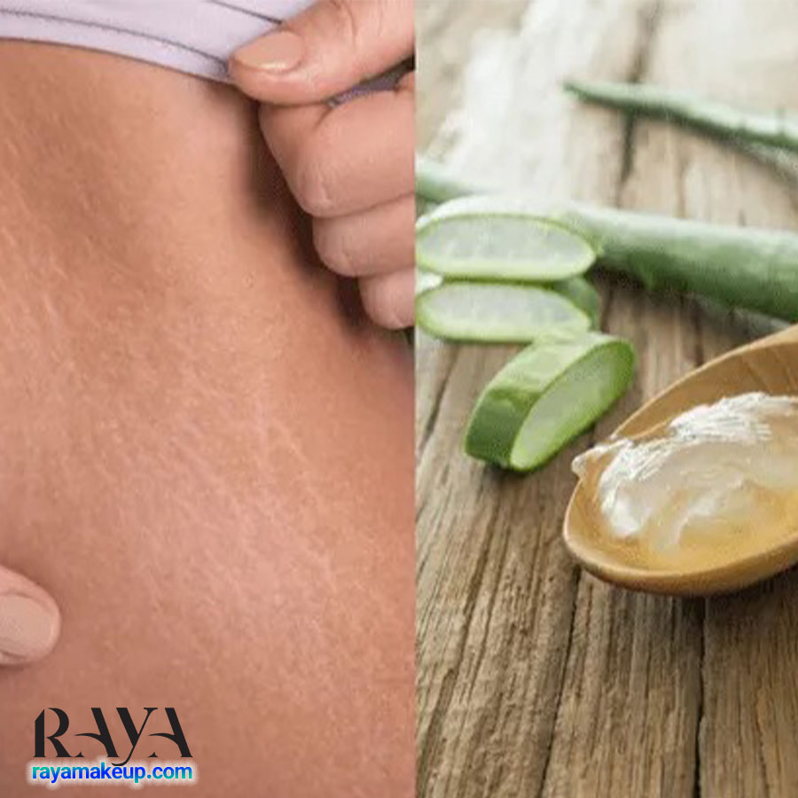 چگونه از آلوئه ورا برای درمان ترک های پوستی و استرچ مارک استفاده کنیم؟