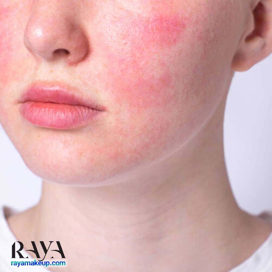 چگونه از آلوئه ورا برای درمان ترک های پوستی و استرچ مارک استفاده کنیم؟