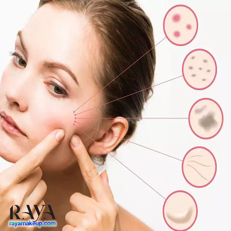 علت آکنه در قسمت های مختلف صورت: جوش هایتان چه می خواهند به شما بگویند؟