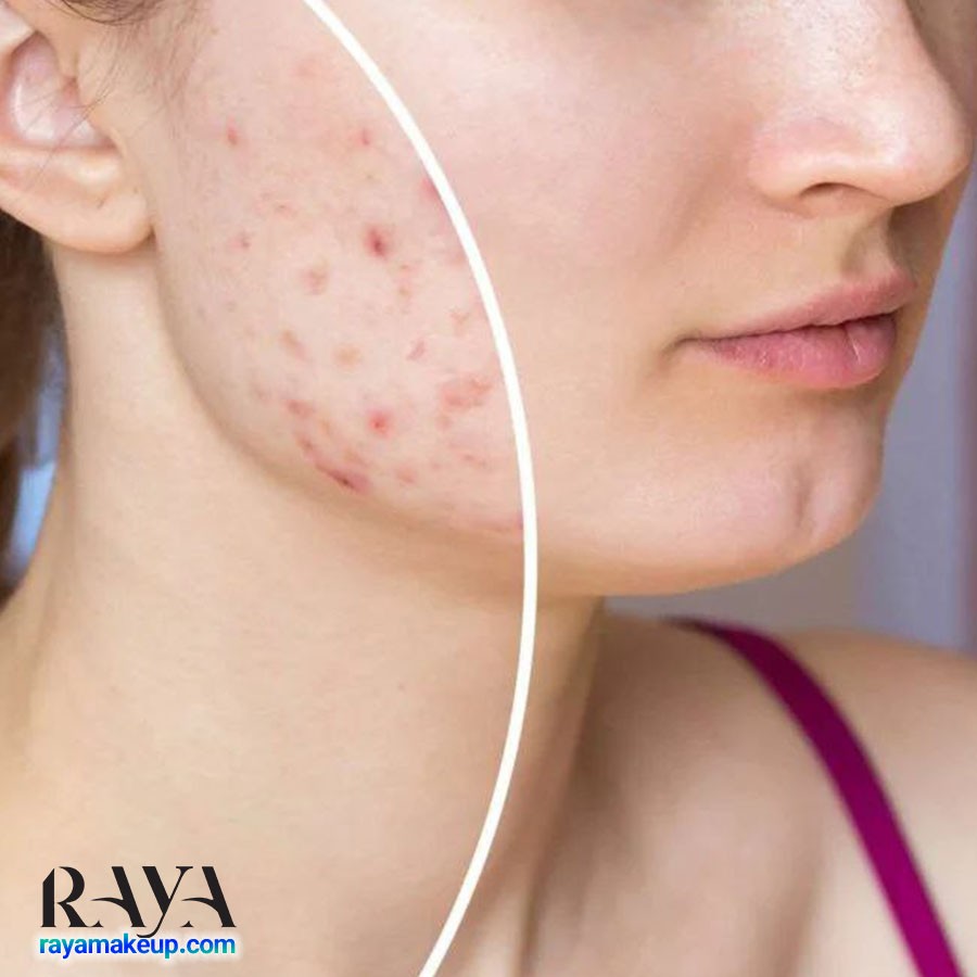 علت آکنه در قسمت های مختلف صورت: جوش هایتان چه می خواهند به شما بگویند؟
