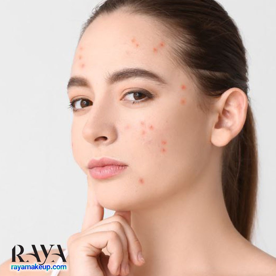 علت آکنه در قسمت های مختلف صورت: جوش هایتان چه می خواهند به شما بگویند؟