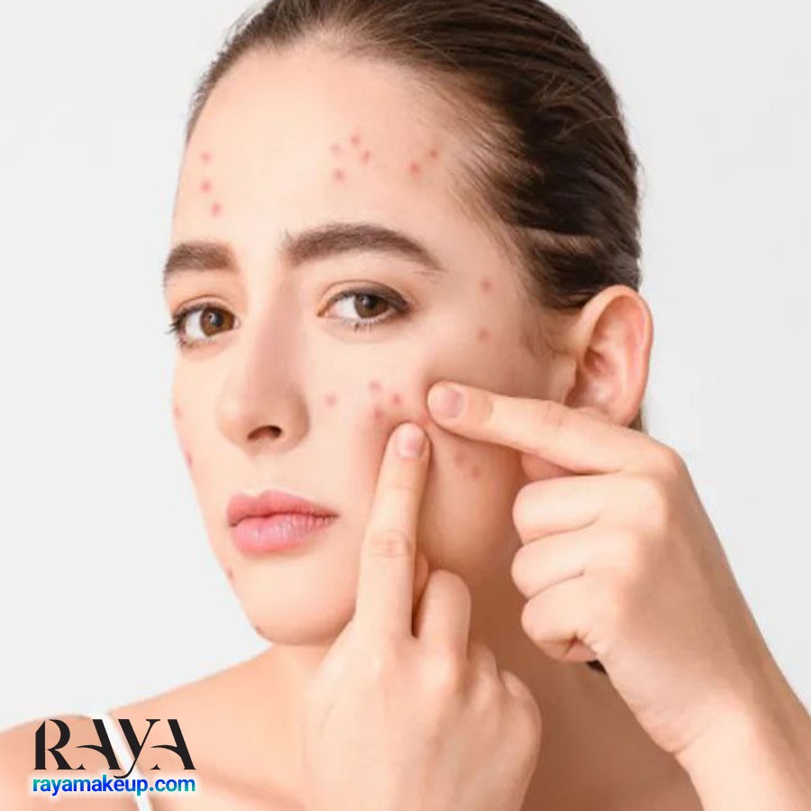 علت آکنه در قسمت های مختلف صورت: جوش هایتان چه می خواهند به شما بگویند؟