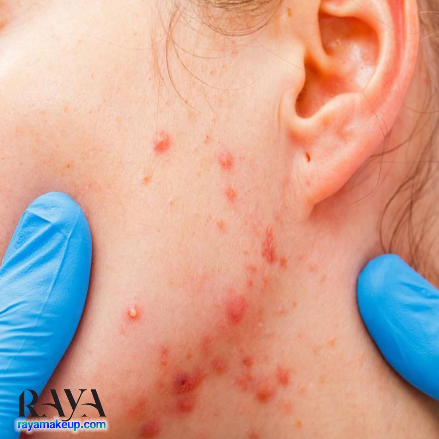 آیا دست زدن به پوست صورت باعث ایجاد جوش و آکنه می شود؟