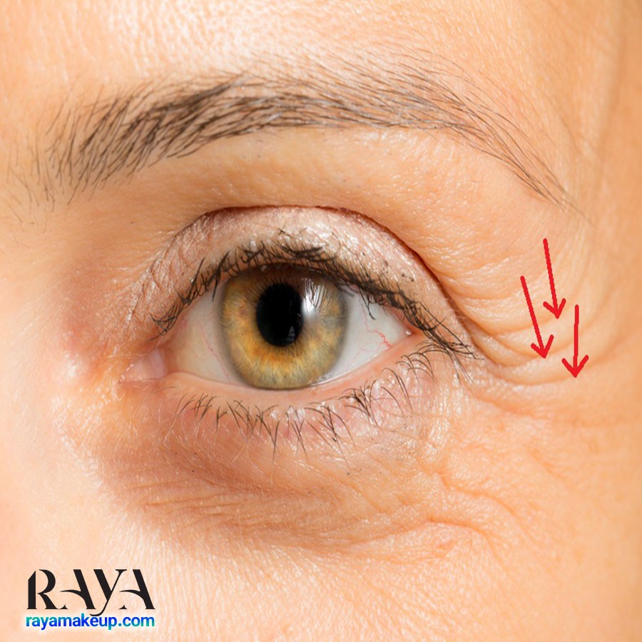 چگونه از شر خطوط پنجه کلاغی گوشه چشم خلاص شویم؟ راهکارهای درمان و پیشگیری از آن