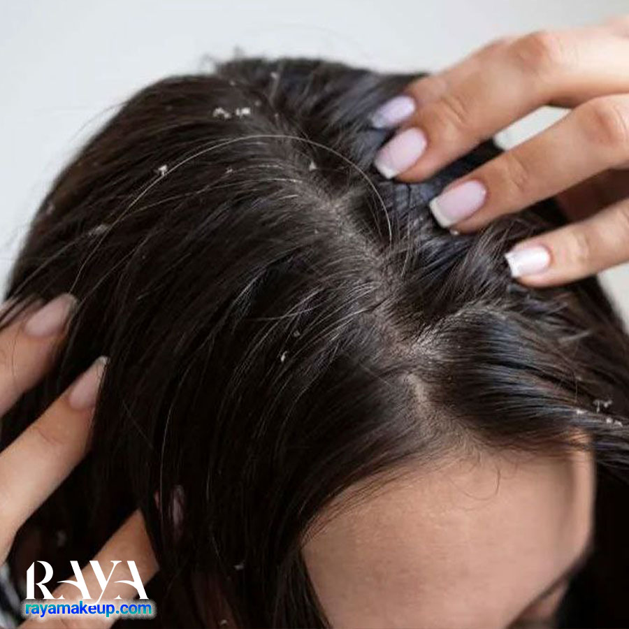 چگونه با روش های طبیعی از شر شوره سر در زمستان خلاص شویم؟