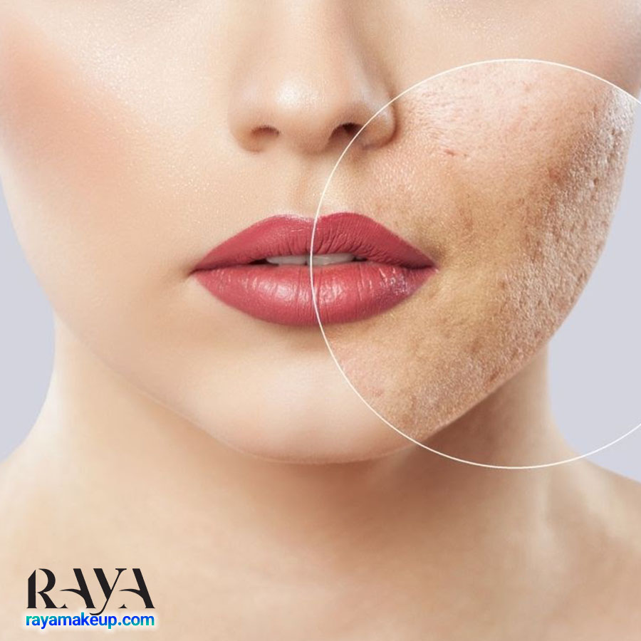 چگونه از شر منافذ باز پوست خلاص شویم؟ (آموزش 21 ماسک خانگی برای درمان منافذ باز پوست)