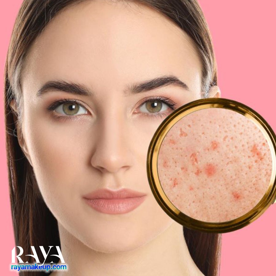 همه چیز درباره جوش و آکنه های بین ابروها