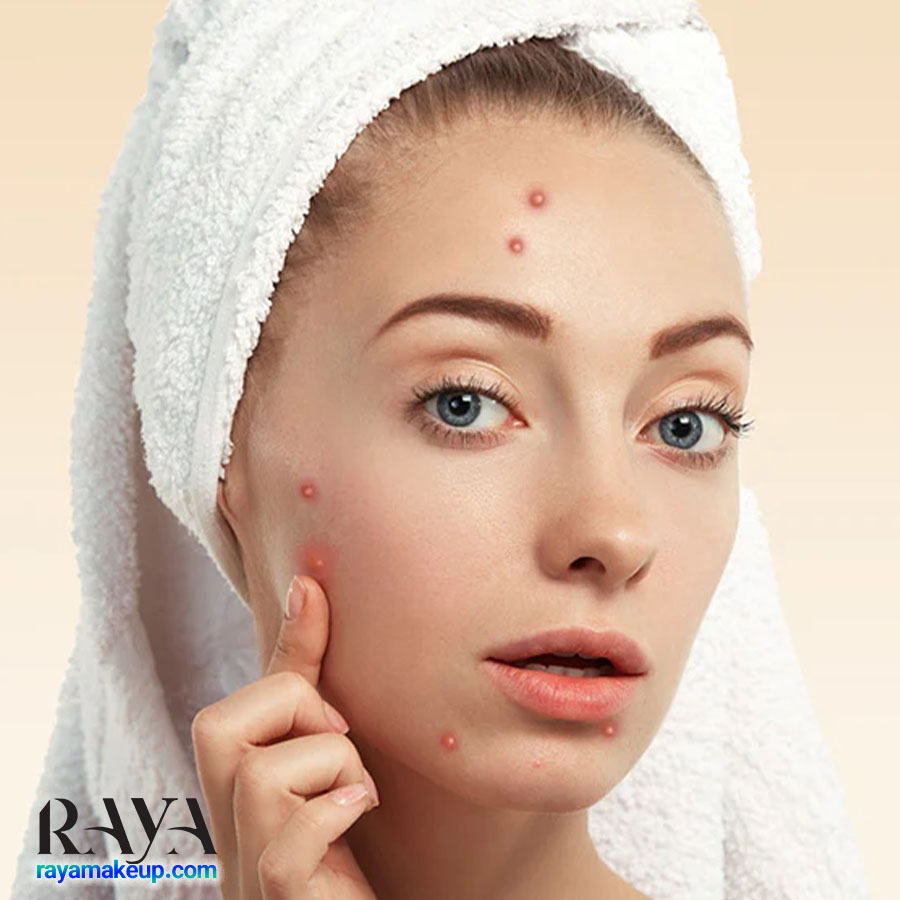 آموزش 15 ماسک صورت خانگی آسان برای پوست های چرب و مستعد جوش و آکنه 