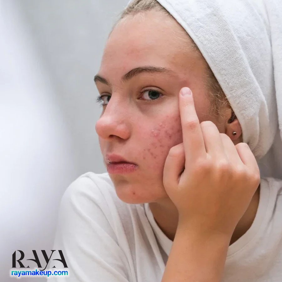 آموزش 15 ماسک صورت خانگی آسان برای پوست های چرب و مستعد جوش و آکنه