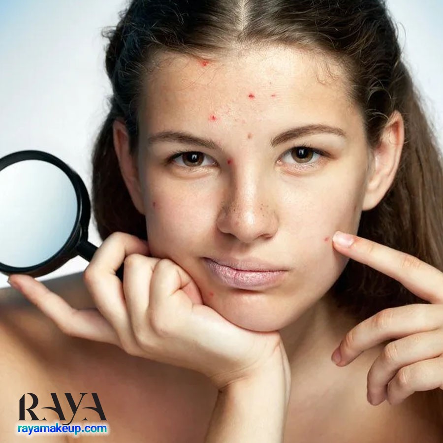 چگونه جوش های سر سیاه روی چانه را از بین ببریم؟ 	