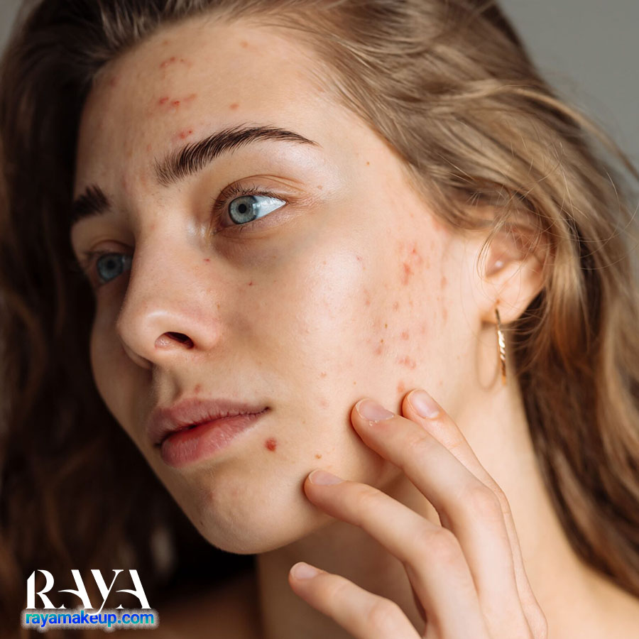 هورمون ها چگونه در مراحل مختلف زندگی روی پوست ما تأثیر می گذارند؟