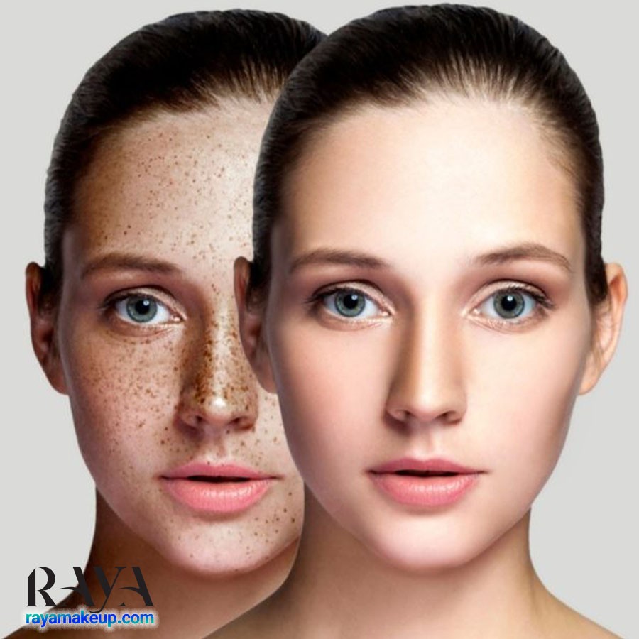 چگونه از شر لک های تیره و هایپرپیگمنتاسیون روی باسن خلاص شویم؟	