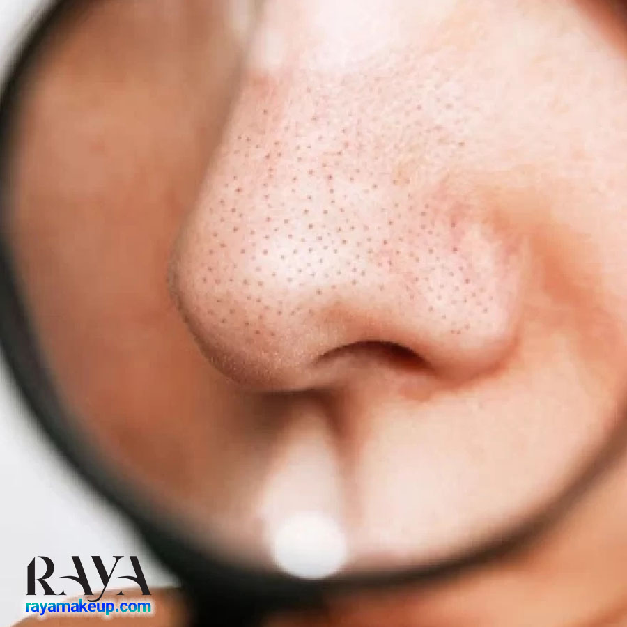 بررسی علل بزرگ شدن منافذ بینی و 12 نکته مهم برای پاکسازی و درمان آنها