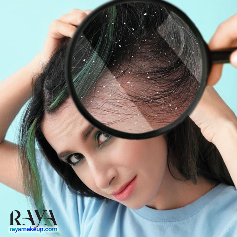 بررسی تفاوت شوره سر با خشکی پوست سر به همراه علائم و درمان های آنها 