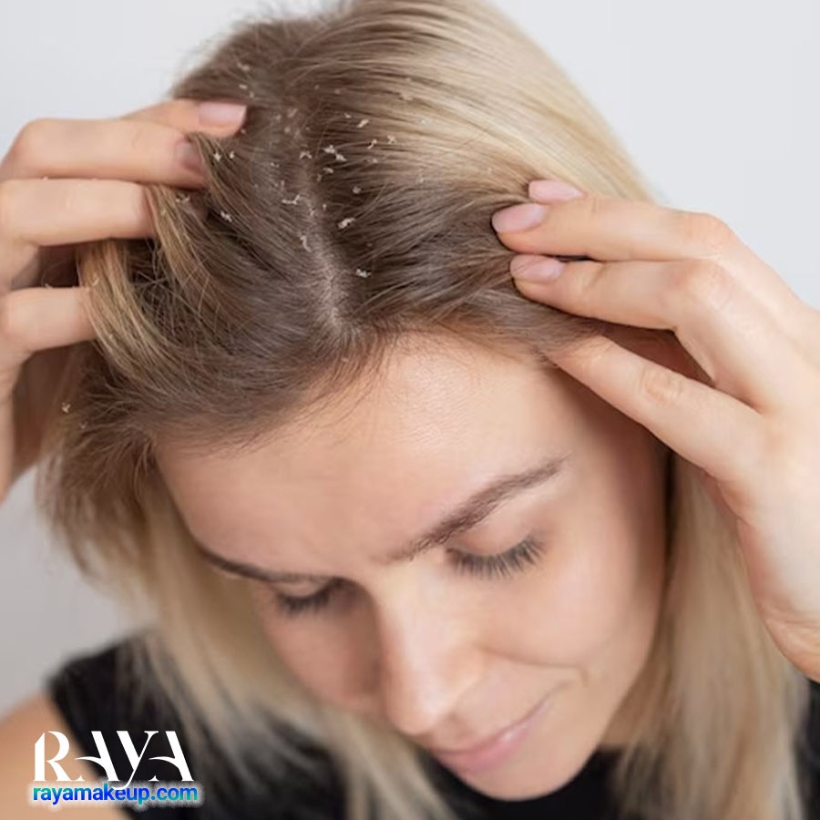 بررسی تفاوت شوره سر با خشکی پوست سر به همراه علائم و درمان های آنها 	
