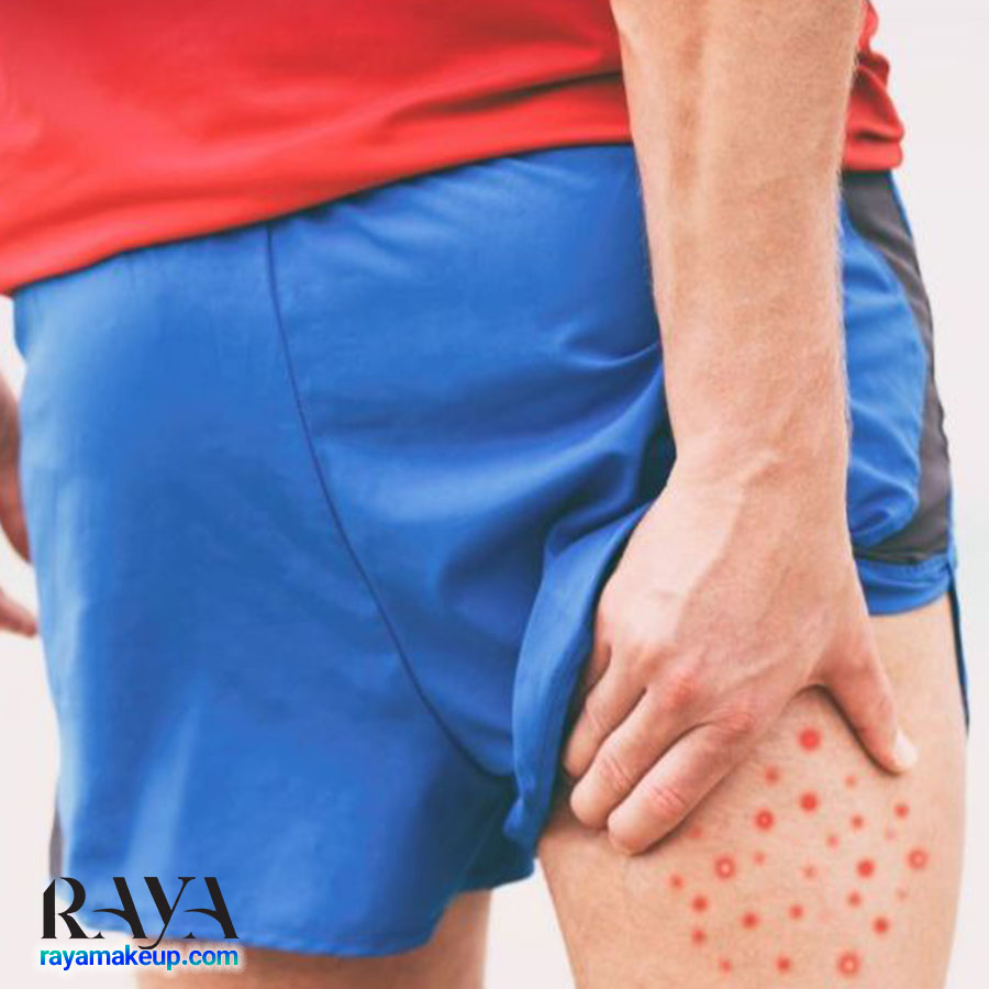 چگونه جوش های روی باسن را به روش خانگی از بین ببریم؟