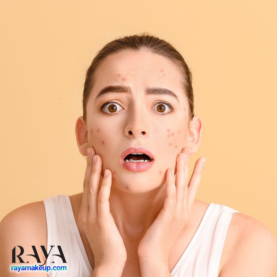 چگونه جوش های روی باسن را به روش خانگی از بین ببریم؟