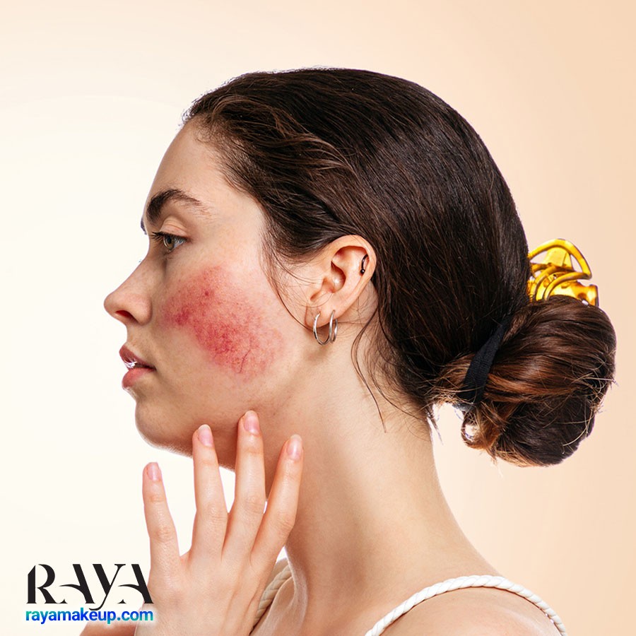 چگونه روزاسه و قرمزی پوست را در خانه درمان کنیم؟ 	
