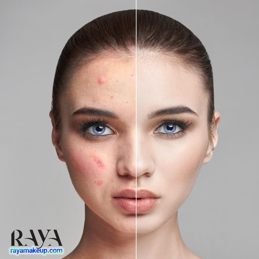 برای داشتن پوستی شفاف و سالم و بدون آکنه چه بخوریم؟