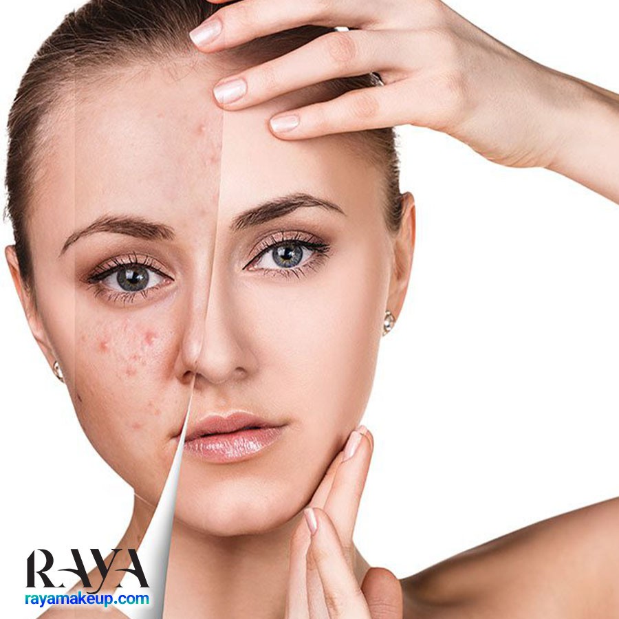 برای داشتن پوستی شفاف و سالم و بدون آکنه چه بخوریم؟