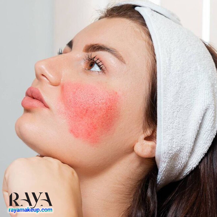 تفاوت سدیم هیالورونات و هیالورونیک اسید در چیست؟ 	