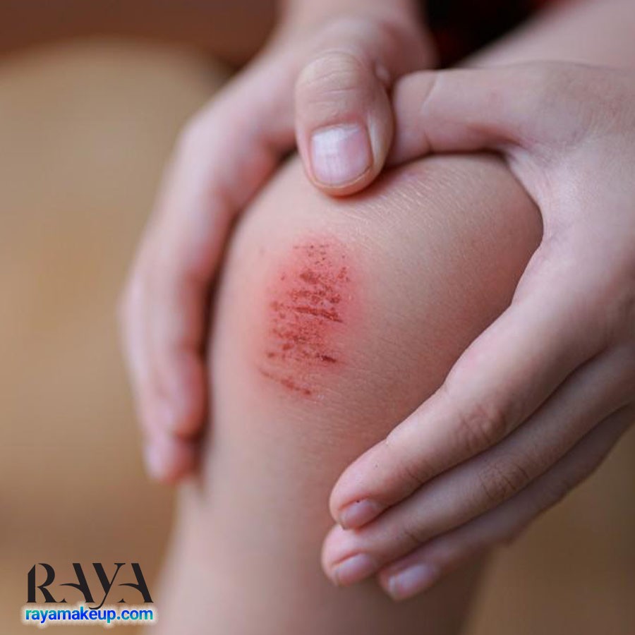 چگونه خراش و ساییدگی پوست را درمان کنیم؟