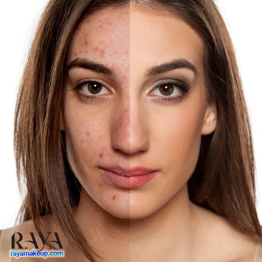 جوش های بعد از اپیلاسیون را چگونه درمان کنیم؟ 