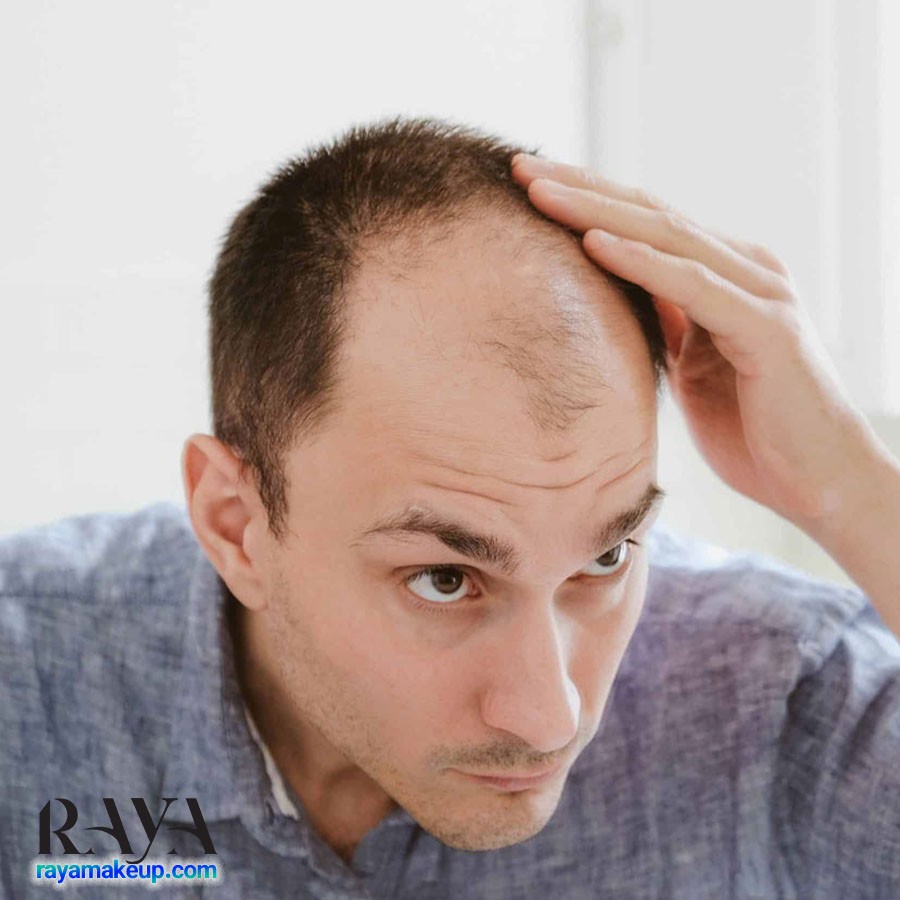 در مورد ریزش موی ژنتیکی چه می دانید؟ آیا ریزش موی ارثی قابل درمان است؟ 	
