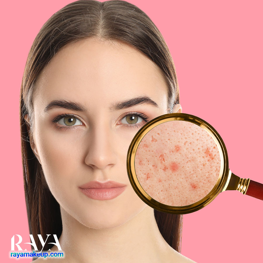 چگونه از شر جوش های ناشی از سندرم تخمدان پلی کیستیک (PCOS) خلاص شویم؟ 