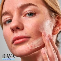 کرم مرطوب کننده ضد لک اینکی لیست حاوی 2٪ نوورتین