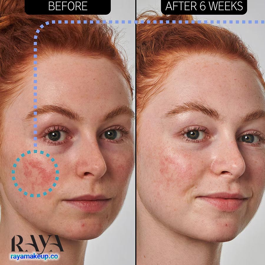 سرم آزلائیک اسید 10% اینکی لیست تسکین دهنده قرمزی پوست The Inkey List 10% Azelaic Acid Serum for Redness Relief