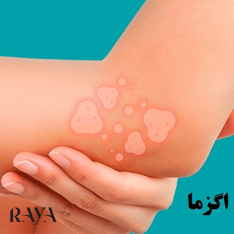 اگزمای پوستی چیست؟ بررسی دلایل و انواع اگزما پوستی