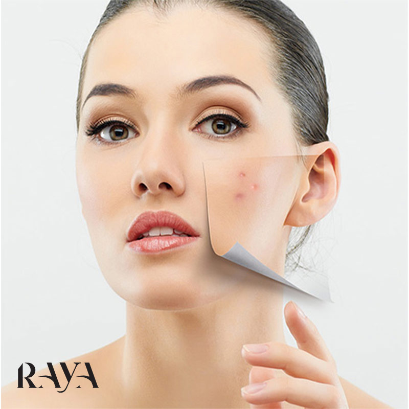 جوش های زیر پوستی، دلایل و راه های خانگی رفع جوش زیرپوستی