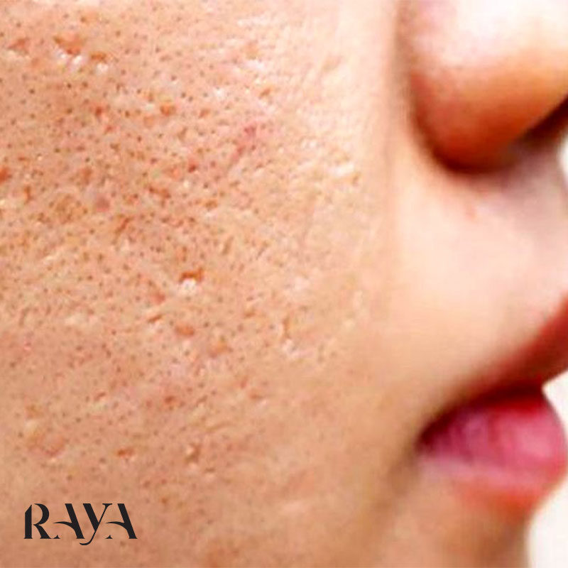راه های کوچک کردن منافذ باز پوست