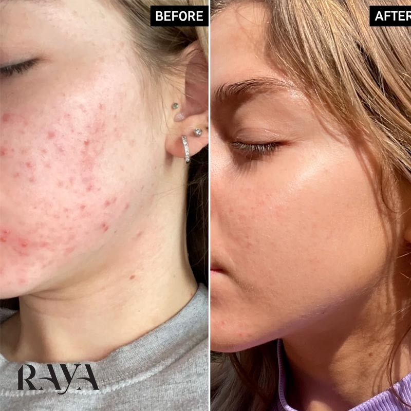 سرم لایه بردار و ضد جوش بتا هیدروکسی اسید یا بی اچ آ اینکی لیست The Inkey List Beta Hydroxy Acid (BHA) Serum