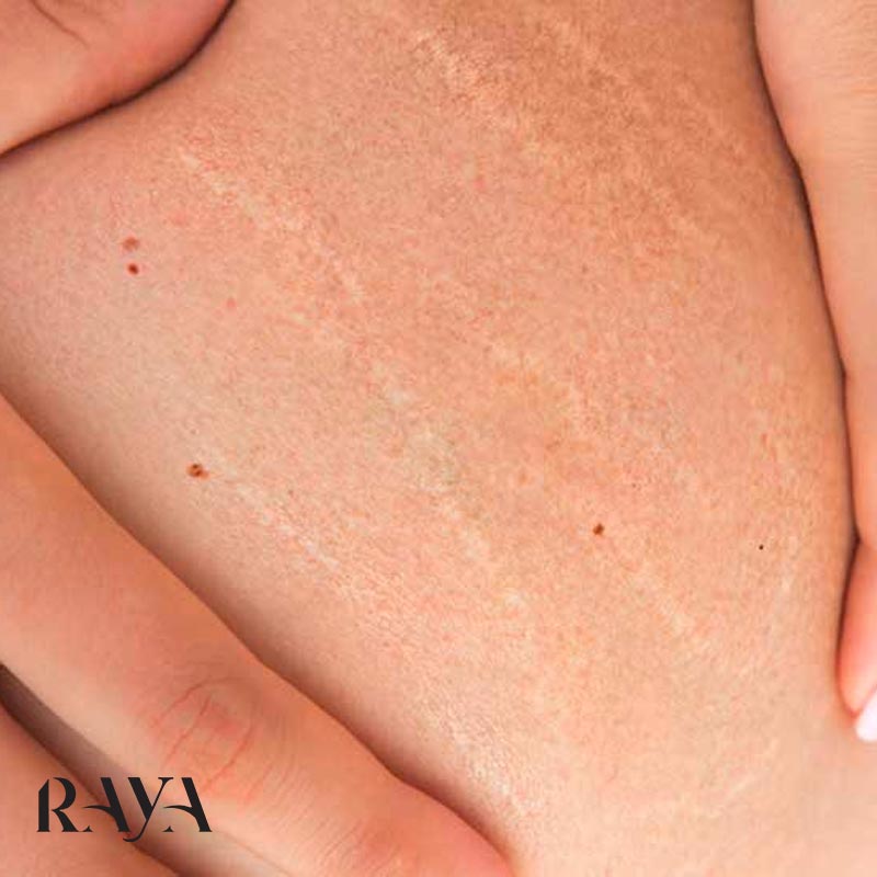 دلایل ایجاد ترک های پوستی یا آستریا و راهکارهای مقابله با آن