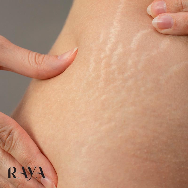 دلایل ایجاد ترک های پوستی یا آستریا و راهکارهای مقابله با آن