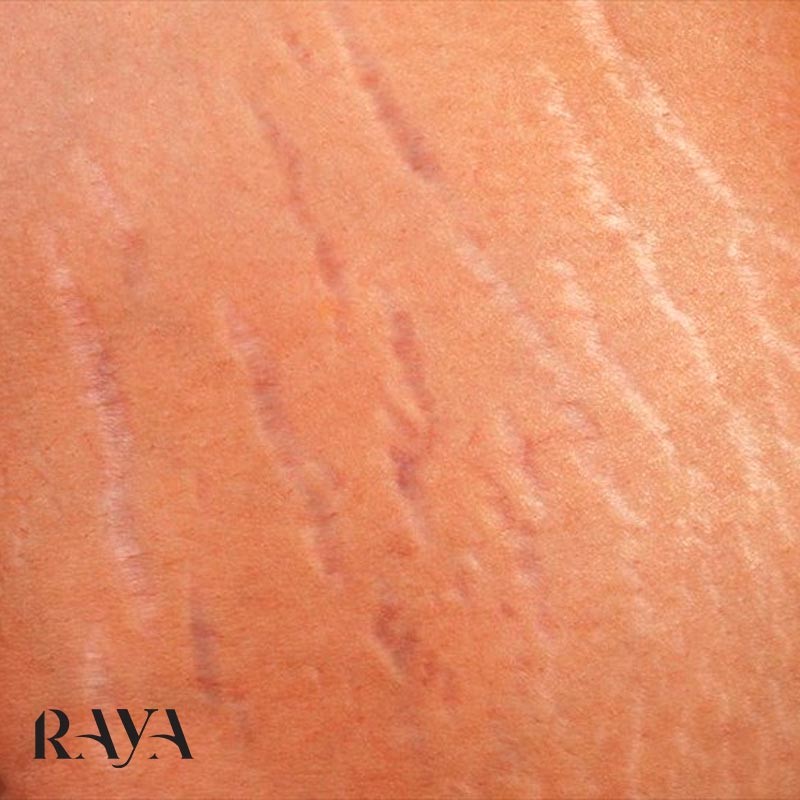دلایل ایجاد ترک های پوستی یا آستریا و راهکارهای مقابله با آن