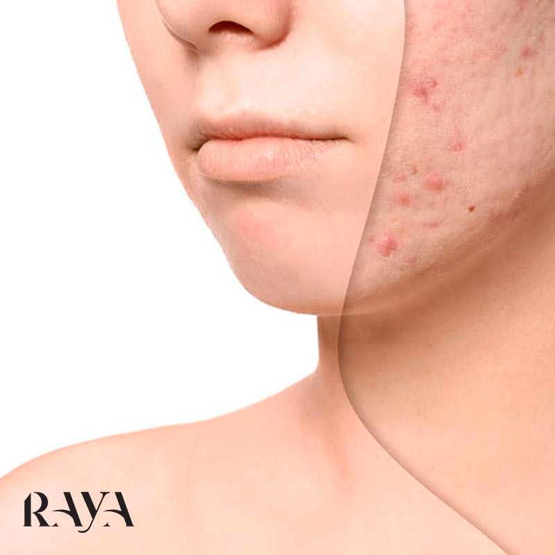 چگونه فرورفتگی جای جوش و آکنه ها را درمان کنیم؟