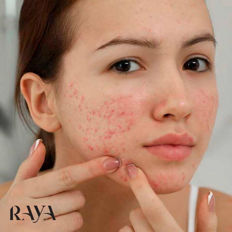 چگونه فرورفتگی جای جوش و آکنه ها را درمان کنیم؟