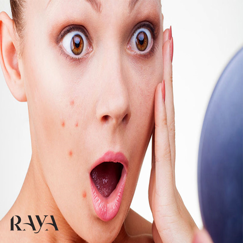کدام ضد جوش برای من مناسب تر است؟
