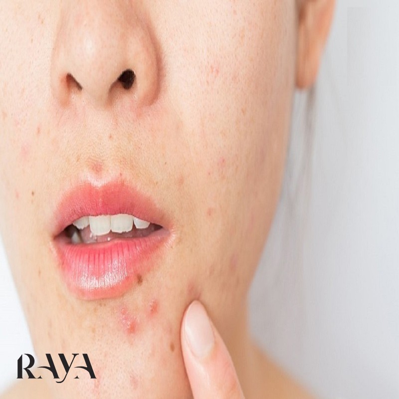 کدام ضد جوش برای من مناسب تر است؟