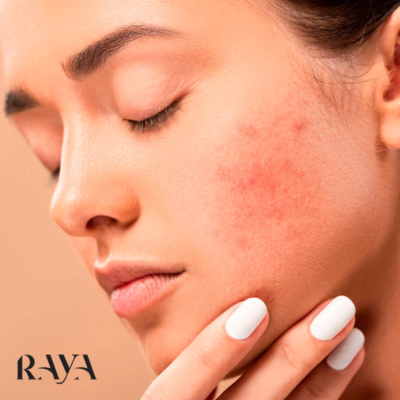 برای درمان جوش های صورت چه کار کنم؟
